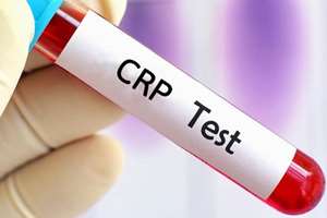 بررسی ارزش تشخیصی نسبت CRP به آلبومین در پیشبینی ایسکمی میوکارد با کمک سینتی گرافی پرفیوژن میوکارد